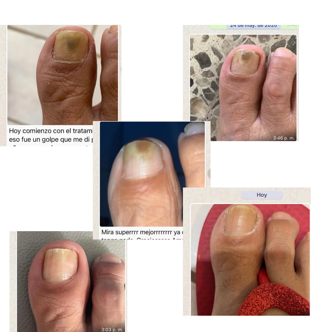 FUNGUS RELIEF